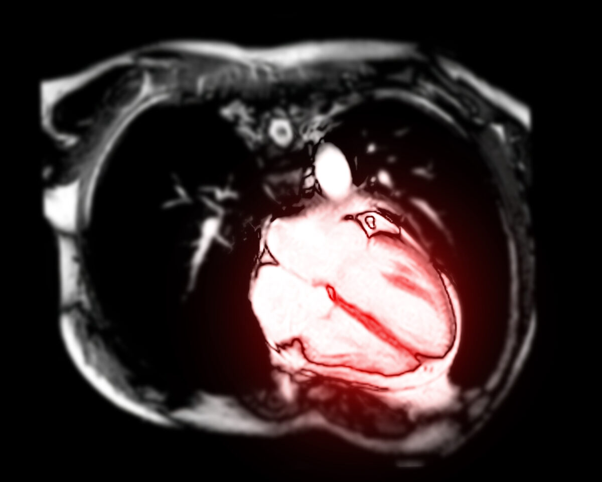How the Spike Protein Hurts the Heart How the Spike Protein Hurts the Heart