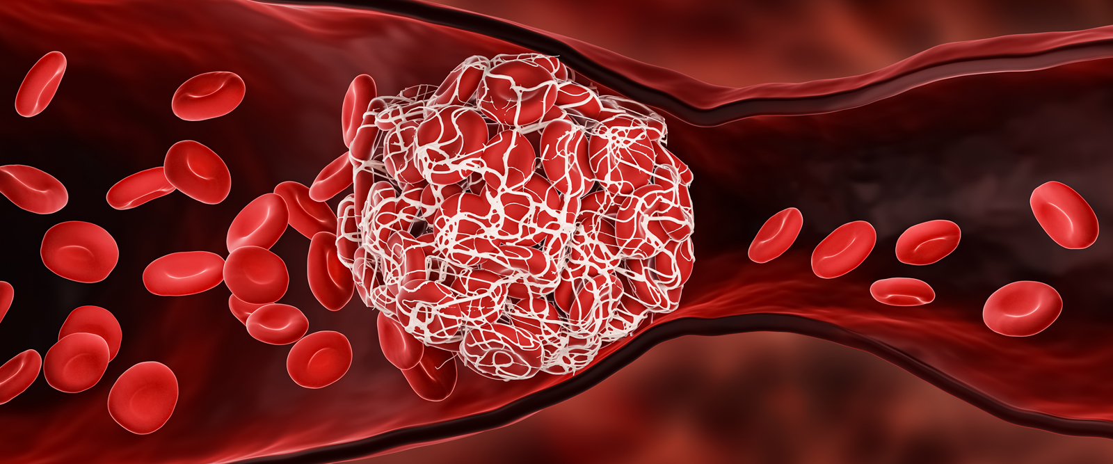 What to Know About Blood Clots and COVID-19