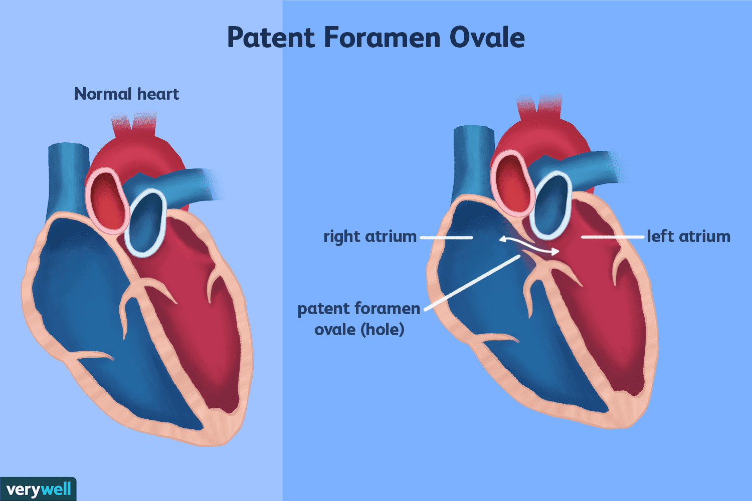 Patent foramen ovale