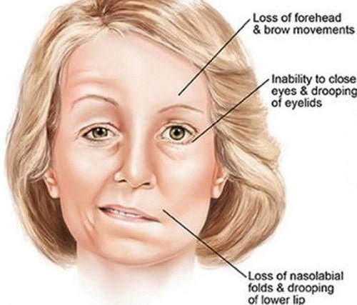 Facial nerve paralysis