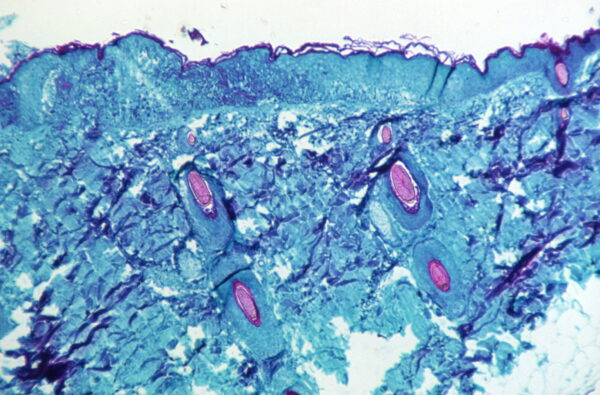 Monkeypox skin