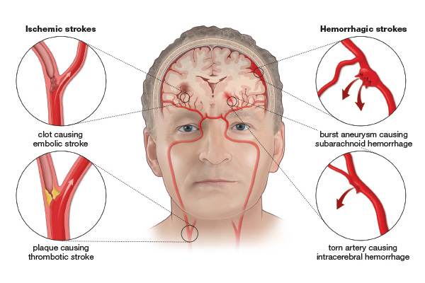 Stroke Facts & Statistics - Stroke Awareness Foundation