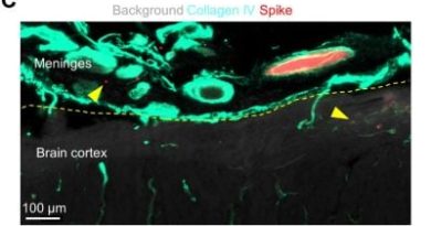 Spike Protein Accumulates in the Brain and Causes Infarcts, Bleeds, Inflammation – Pfizer & Moderna COVID-19 mRNA Vaccines Cause Severe Neurological Injuries