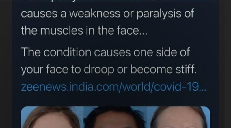 Did 4 COVID-19 Vaccine Trial Patients Develop Bell's Palsy?