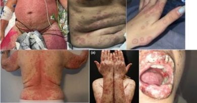 Erythema Multiforme After Pfizer and Moderna COVID-19 mRNA Vaccines - Global Research