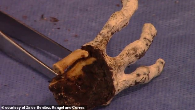 Dissection has begun on these hands from one of Peru's macabre and hotly debated 'alien mummies' - seen in eerie new videos revealing two of its apparent 'metacarpal' or 'palm' bones (above) as well as a thin, eerie metallic structure