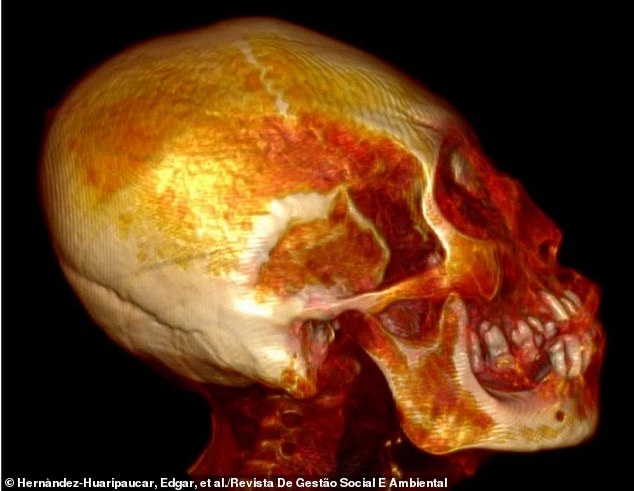 The elongated skull showed no signs of artificial cranial deformation and was 30 percent larger than that of a normal human